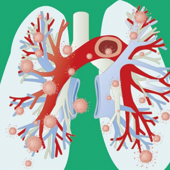 Тромбоемболія легеневої артерії: причини та симптоми
