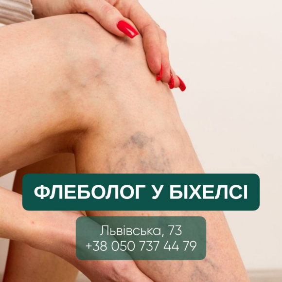 Здоров’я вен нижніх кінцівок: коли варто звернутися до флеболога у Біхелсі